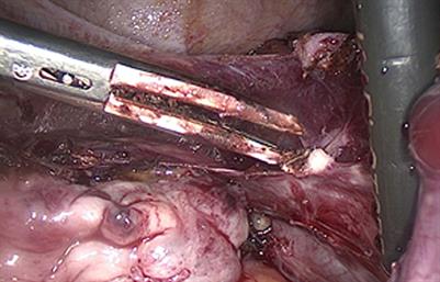 Case Report: Laparoscopic Management of an Ectopic Pregnancy in a Rudimentary Non-communicating Uterine Horn